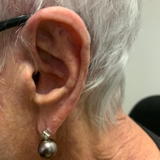 Custom CIC Hearing Aid